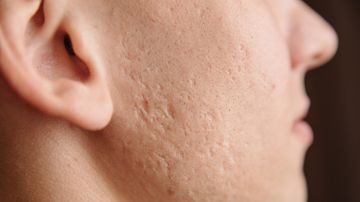 Cómo tratar naturalmente las cicatrices del acné