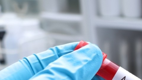 OMS alerta sobre brote de ántrax en África y se puede extender a otros países