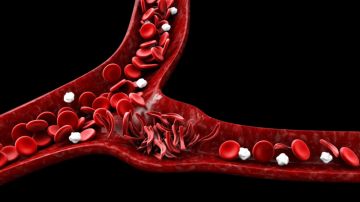 La FDA podría aprobar un nuevo tratamiendo para anemia por células falciformes