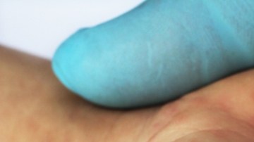 OMS reporta incremento "alarmante" de casos de sarampión en Europa