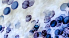 CDC declaran epidemia de sífilis en Estados Unidos