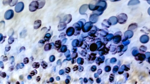 CDC declaran epidemia de sífilis en Estados Unidos