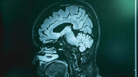 Demencia frontotemporal: de qué se trata y cómo puede afectar aún a los jóvenes