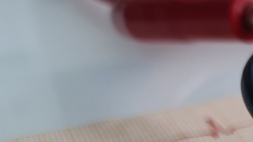 Cómo un marcapasos cerebral podría ayudar a mejorar los síntomas depresivos