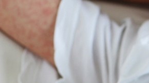 Alerta por cuatro casos de sarampión registrados en una escuela de EE.UU.