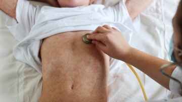 Alerta por cuatro casos de sarampión registrados en una escuela de EE.UU.