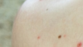 Brote de sarampión va en aumento en Florida: se regitran 8 nuevos contagios