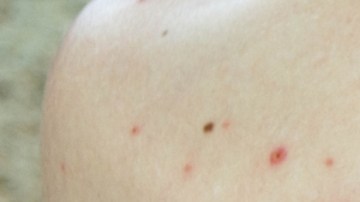 Brote de sarampión va en aumento en Florida: se regitran 8 nuevos contagios