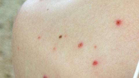 Brote de sarampión va en aumento en Florida: se regitran 8 nuevos contagios
