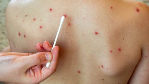 Brote de sarampión va en aumento en Florida: se regitran 8 nuevos contagios