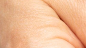 Infecciones por hongos están empeorando en el mundo: qué debes saber