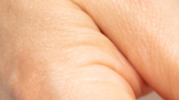 Infecciones por hongos están empeorando en el mundo: qué debes saber