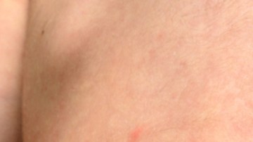 Sarampión en Estados Unidos: qué debes saber