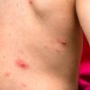 Measles in the United States: What should you know