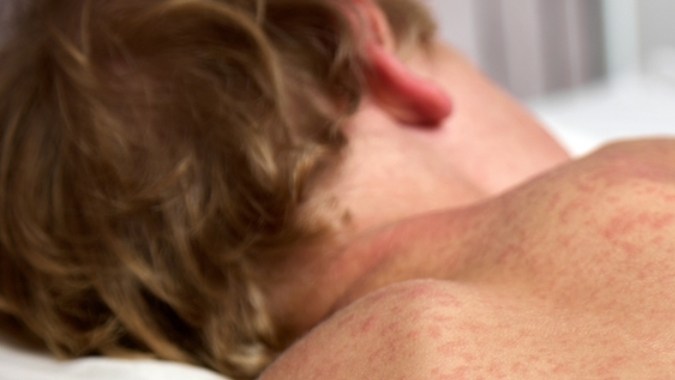 Los CDC y la AMA hacen un llamado urgente a los estadounidenses no vacunados para que se inmunicen contra el sarampión, ya que los casos han igualado o superado los registros de todo el año anterior