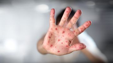 Equipo de los CDC darán respuesta al brote de sarampión en Chicago