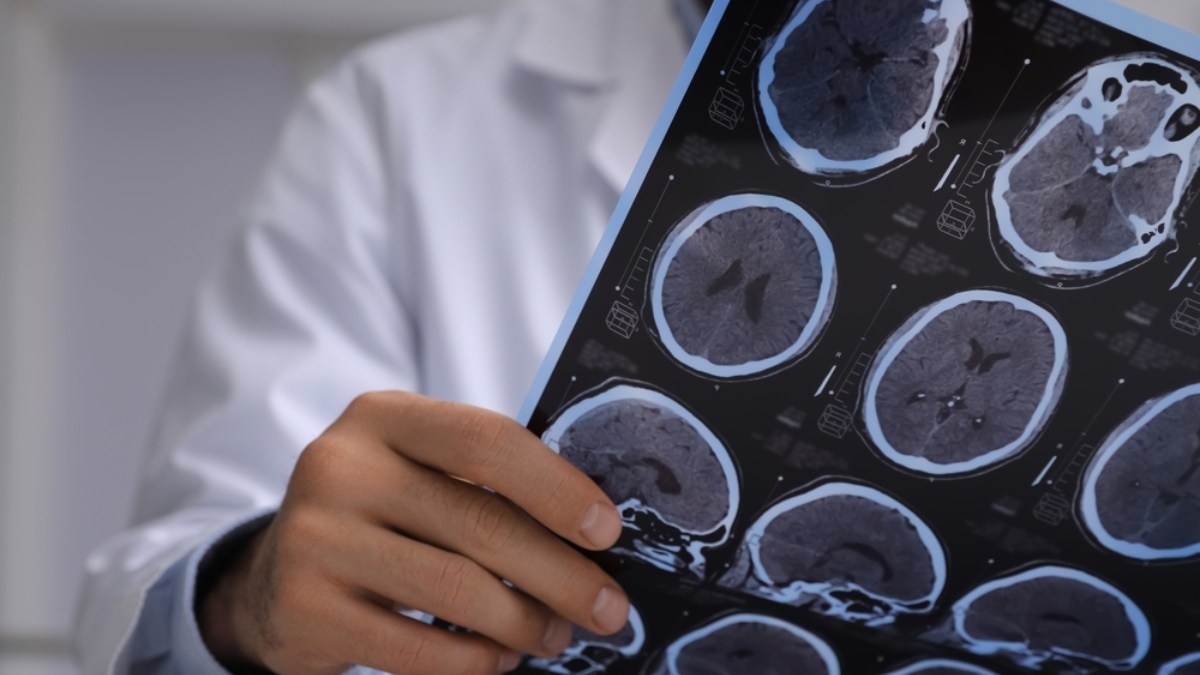 Padre de familia “en forma” es diagnosticado con un tumor cerebral: mostró un extraño síntoma antes de la noticia 