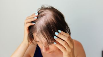 Medicamento para la alopeciafue aprobado en Escocia