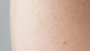 Más de 100 mil personas son diagnosticadas con cáncer de piel cada año en EE.UU.