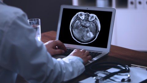 La IA podria rastrear los orígenes de las células cancerosas metastásicas