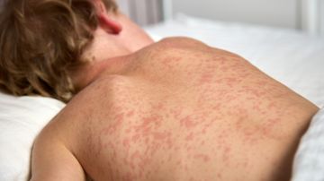 Gales del Sur declara brote de sarampión: qué debemos saber