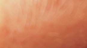 Aumentan casos de sífilis ocular en EE.UU.: de qué se trata