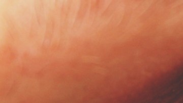 Aumentan casos de sífilis ocular en EE.UU.: de qué se trata