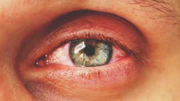 Aumentan casos de sífilis ocular en EE.UU.: de qué se trata