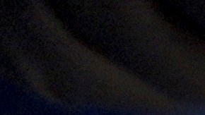 Falleció el primer paciente con trasplante de riñón de cerdo tras siete semanas de la operación