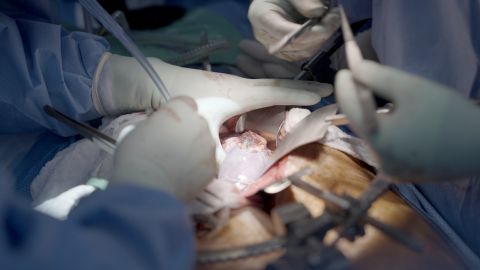 Falleció el primer paciente con trasplante de riñón de cerdo tras siete semanas de la operación
