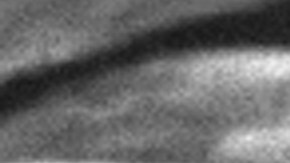 This 2006 electron microscope image provided by the Centers for Disease Control and Prevention shows Mycobacterium tuberculosis bacteria, which causes the disease tuberculosis. The number of U.S. tuberculosis cases in 2023 was the highest in a decade, according to a report released by the CDC on Thursday, March 28, 2024. (Janice Carr/CDC via AP)