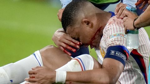 Kylian Mbappé terminó con la nariz fracturada.