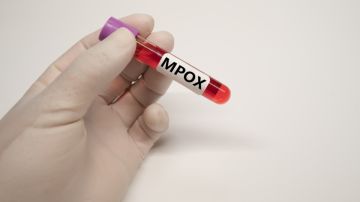 Registran la segunda muerte por Mpox en Sudáfrica
