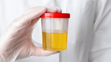Cáncer de cuello uterino podría detectarse con una simple prueba de orina