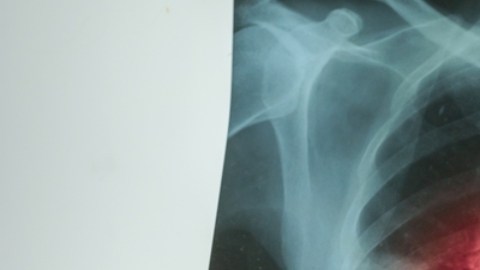El virus del Covid-19 permanece hasta dos años en el cuerpo según radiografías