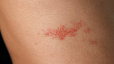 Vacuna contra el herpes zóster podría retrasar la demencia