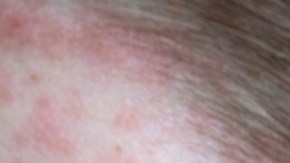 Massachusetts informa el primer caso de sarampión en cuatro años