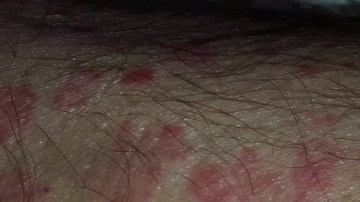 Detectan casos de fiebre del Valle tras festival de música en California