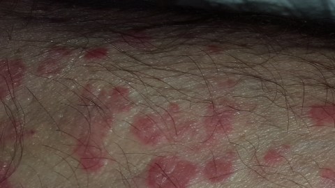 Detectan casos de fiebre del Valle tras festival de música en California