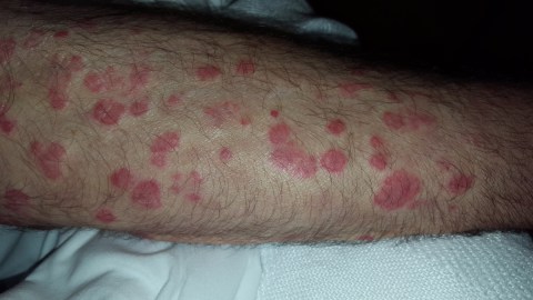 Detectan casos de fiebre del Valle tras festival de música en California