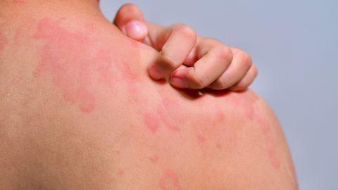 Por qué aumentan las alergias alimentarias entre los niños en el Reino Unido