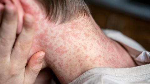 White,Teenager,Covered,In,Measles,Rash,,Infectious,Diseases.