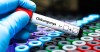 CDC investigan hospitalizaciones de cinco personas que recibieron vacuna contra el chikungunya