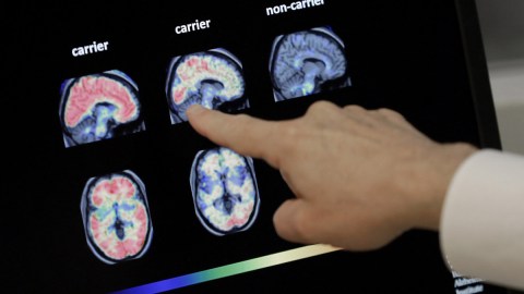 Tomografía del cerebro