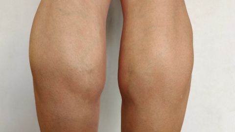 Deporte y coágulos sanguíneos peligrosos: qué debemos hacer