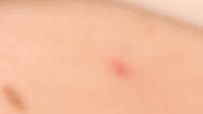 Nueva prueba casera puede identificar el melanoma, el cáncer de piel más agresivo