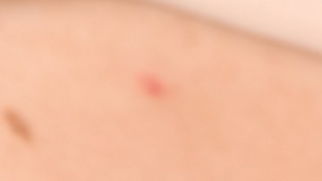 Nueva prueba casera puede identificar el melanoma, el cáncer de piel más agresivo