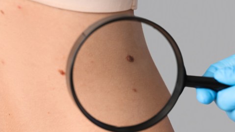 Nueva prueba casera puede identificar el melanoma, el cáncer de piel más agresivo