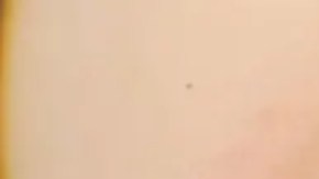 El extractor magnético que extrajo la metralla del corazón de Serhiy.