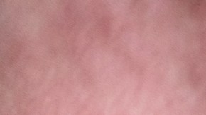 Kansas también declara el fin del brote de sarampión: mientras el total en Wisconsin aumenta